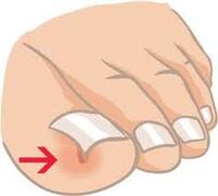 Uñas Encarnadas